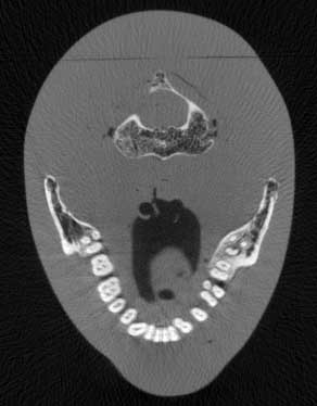 Exxim. X-ray imaging and cone-beam CT. Head phantom.Teeth.