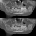 CMPR view of a tomographic dental image. Feldkamp reconstruction.  Feldkamp Artifact Reduction Algorithm