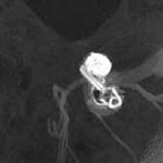 MIP view of a tomographic angiography image