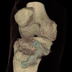 Volume rendering of a tomographic image of a human knee